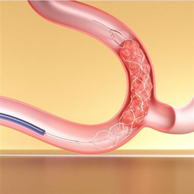 Stent Retriever pentinat amb catèter d'aspiració